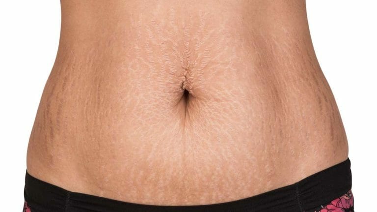 How to get rid of stretch marks in a week?
